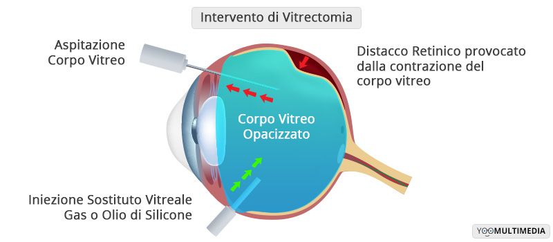 Intervento_Vitrectomia-70a6602d