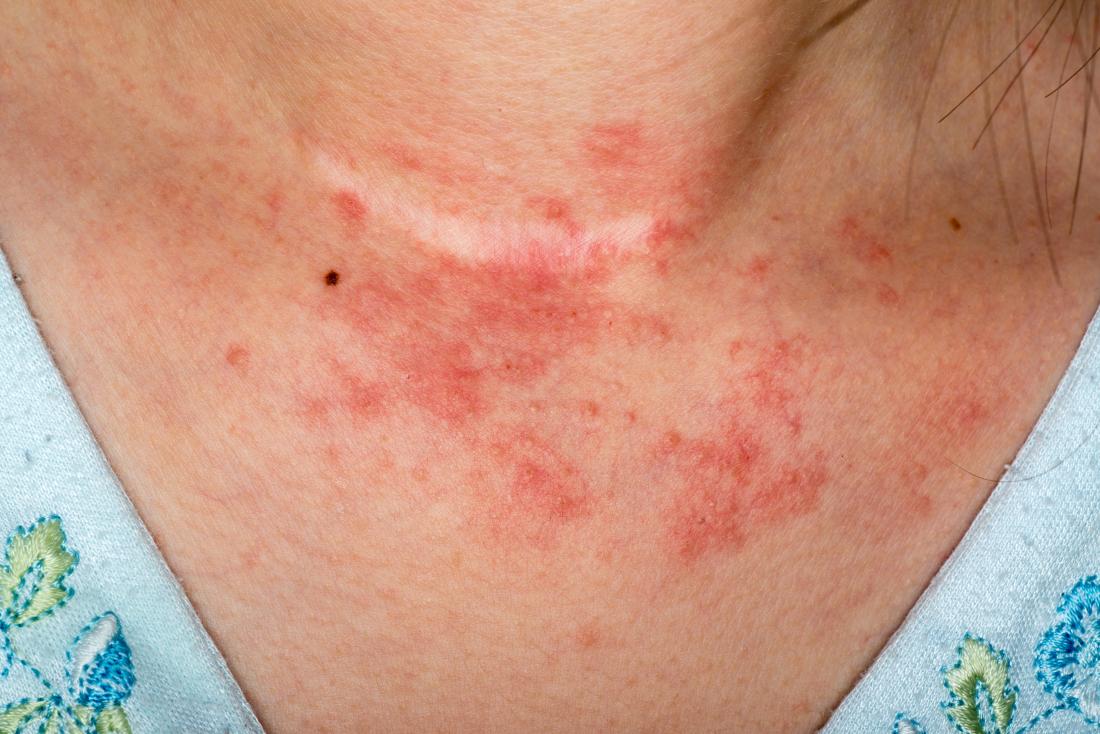 atopic-eczema