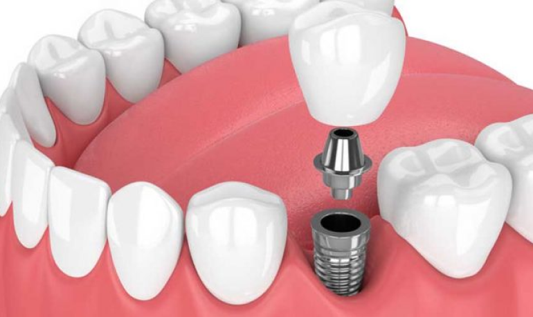 dental-gb-impianto-dentale