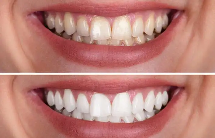 Best-teeth-whitening-treatment-in-Albania-707x455