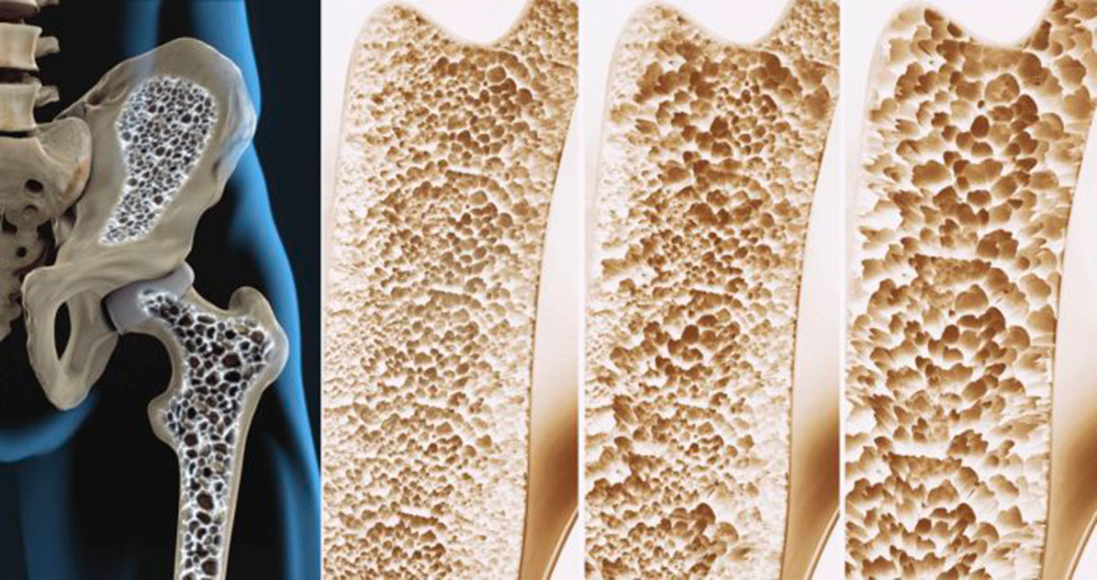 osteoporosi-ossa-fragili-fratture
