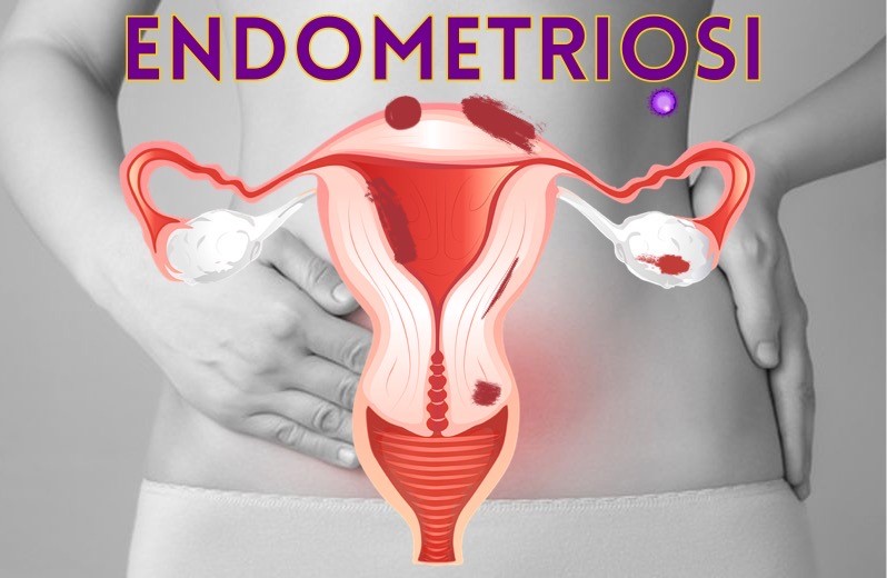 endometriosi_cose_e_come_si_cura_2405