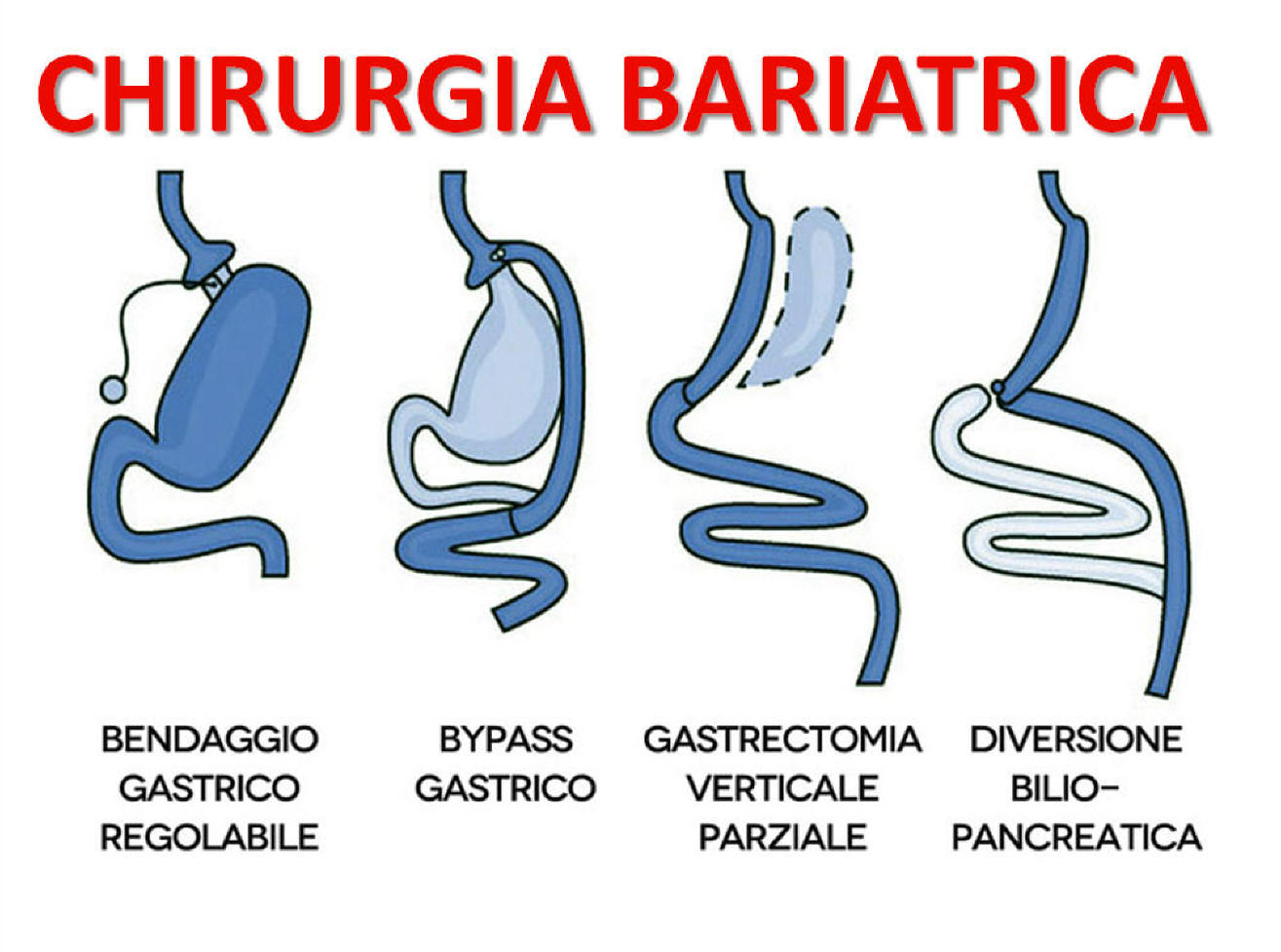 chirururgia-bariatrica1